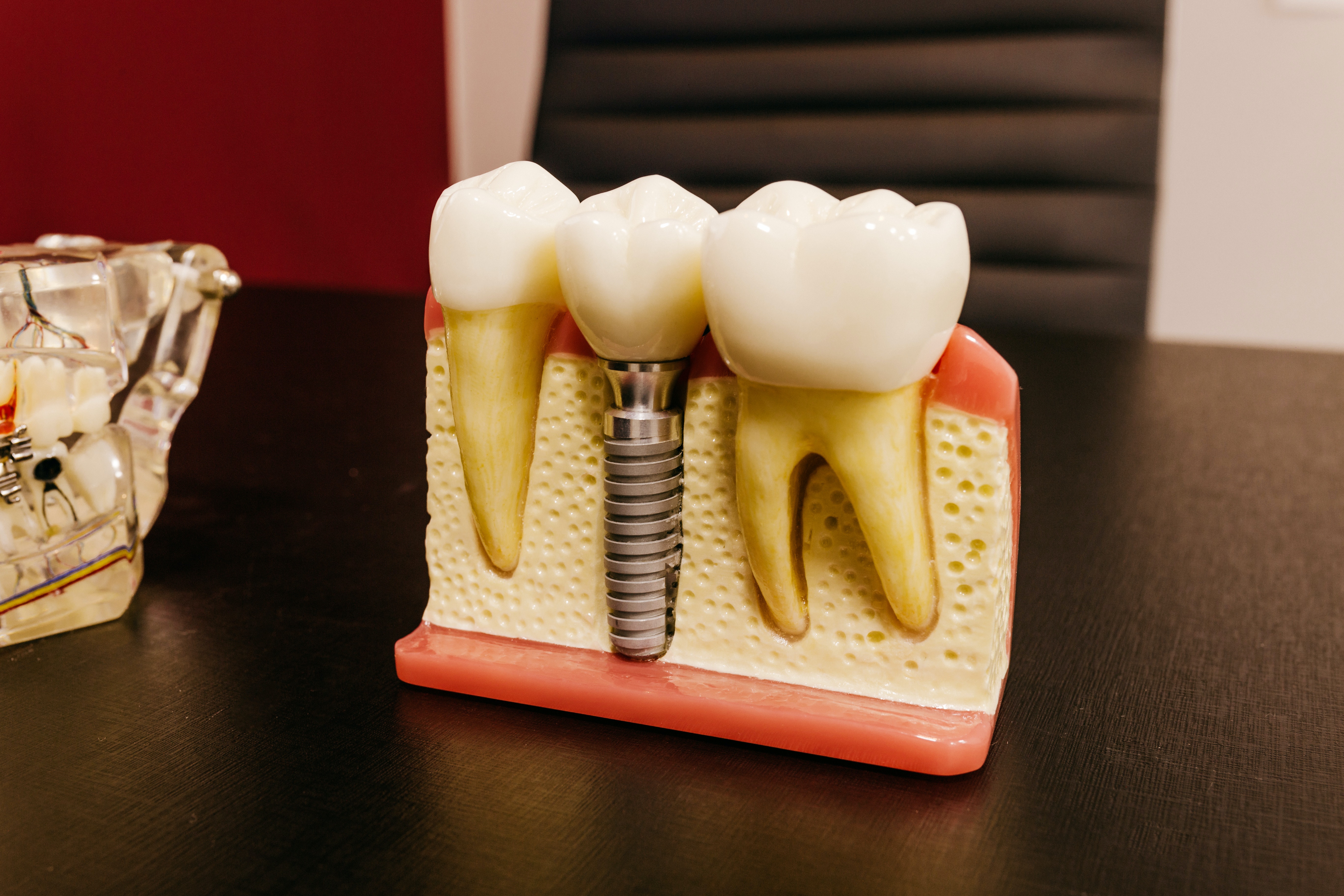 Zubné implantáty